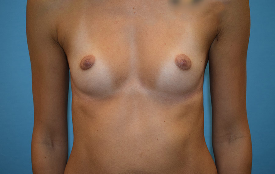 Augmentace prsou 9 (před) 