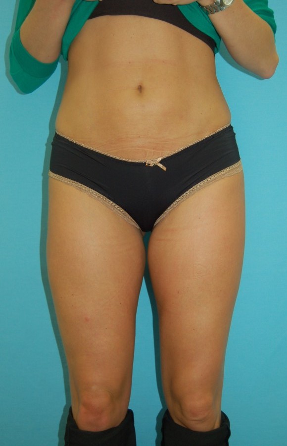 Liposuction 1 (after) 