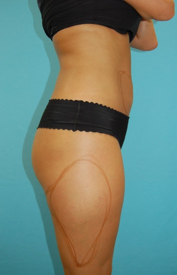 Liposuction 1 (before) 